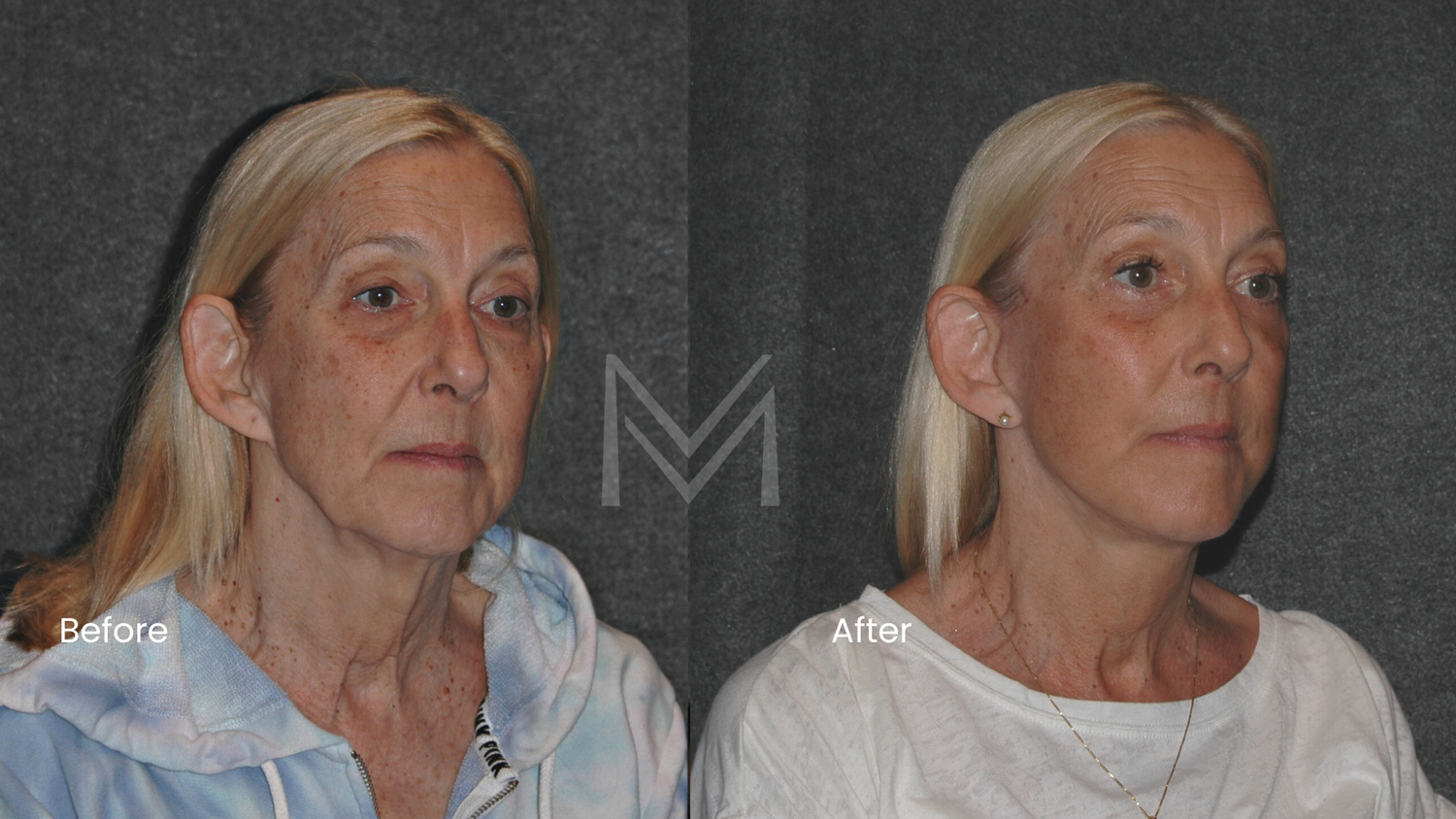Extended deep plane facelift, neck lift, lower blepharoplasty, and fat transfer patient — angled view