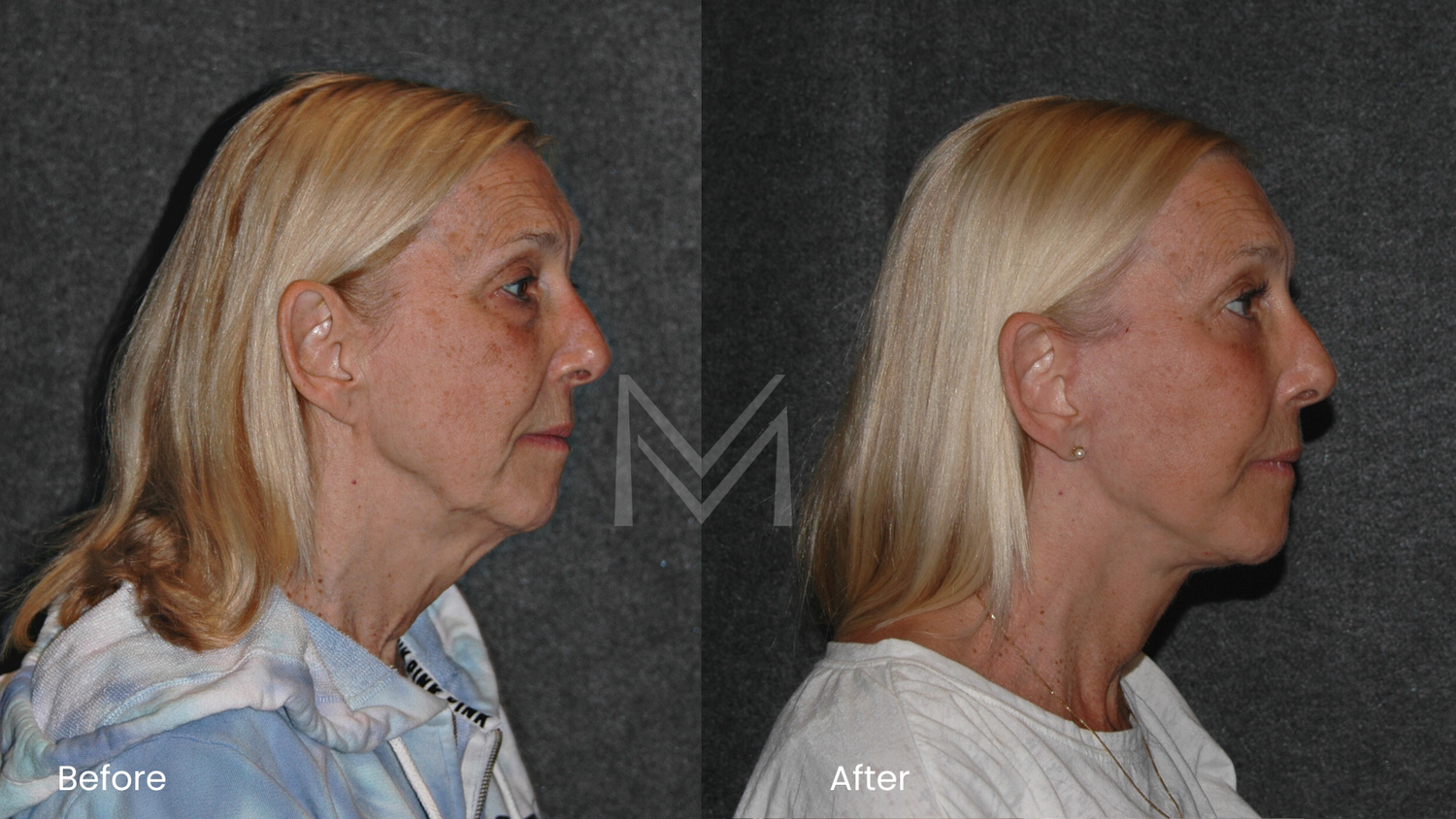 Extended deep plane facelift, neck lift, lower blepharoplasty, and fat transfer patient — side view