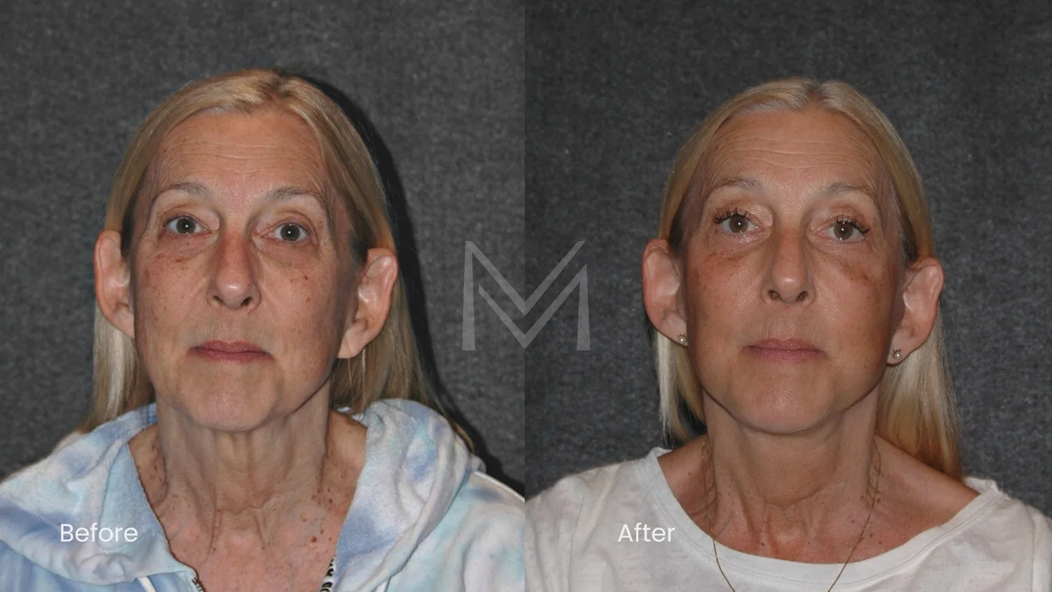 Extended deep plane facelift, neck lift, lower blepharoplasty, and fat transfer patient — front view
