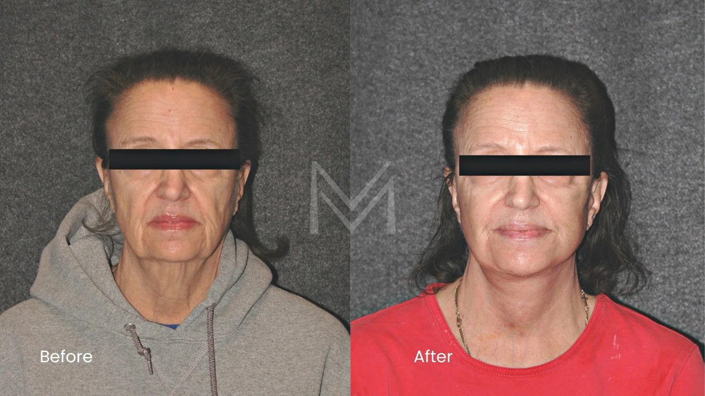Extended deep plane facelift and neck lift patient — front view