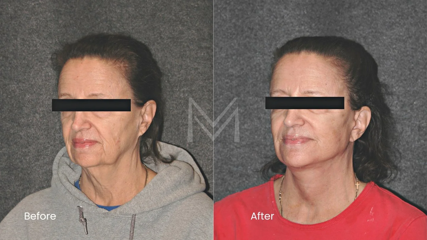 Extended deep plane facelift and neck lift patient — angled view