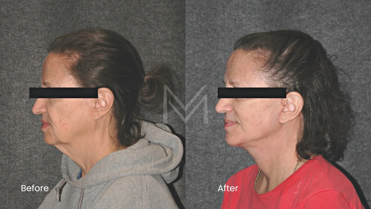 Extended deep plane facelift and neck lift patient — side view