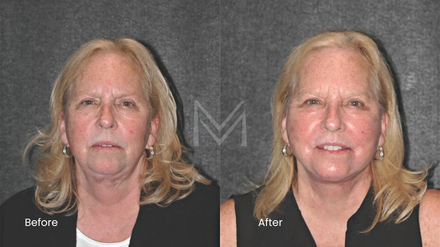 Revision extended deep plane facelift, revision neck lift, and CO2 laser resurfacing patient — front view
