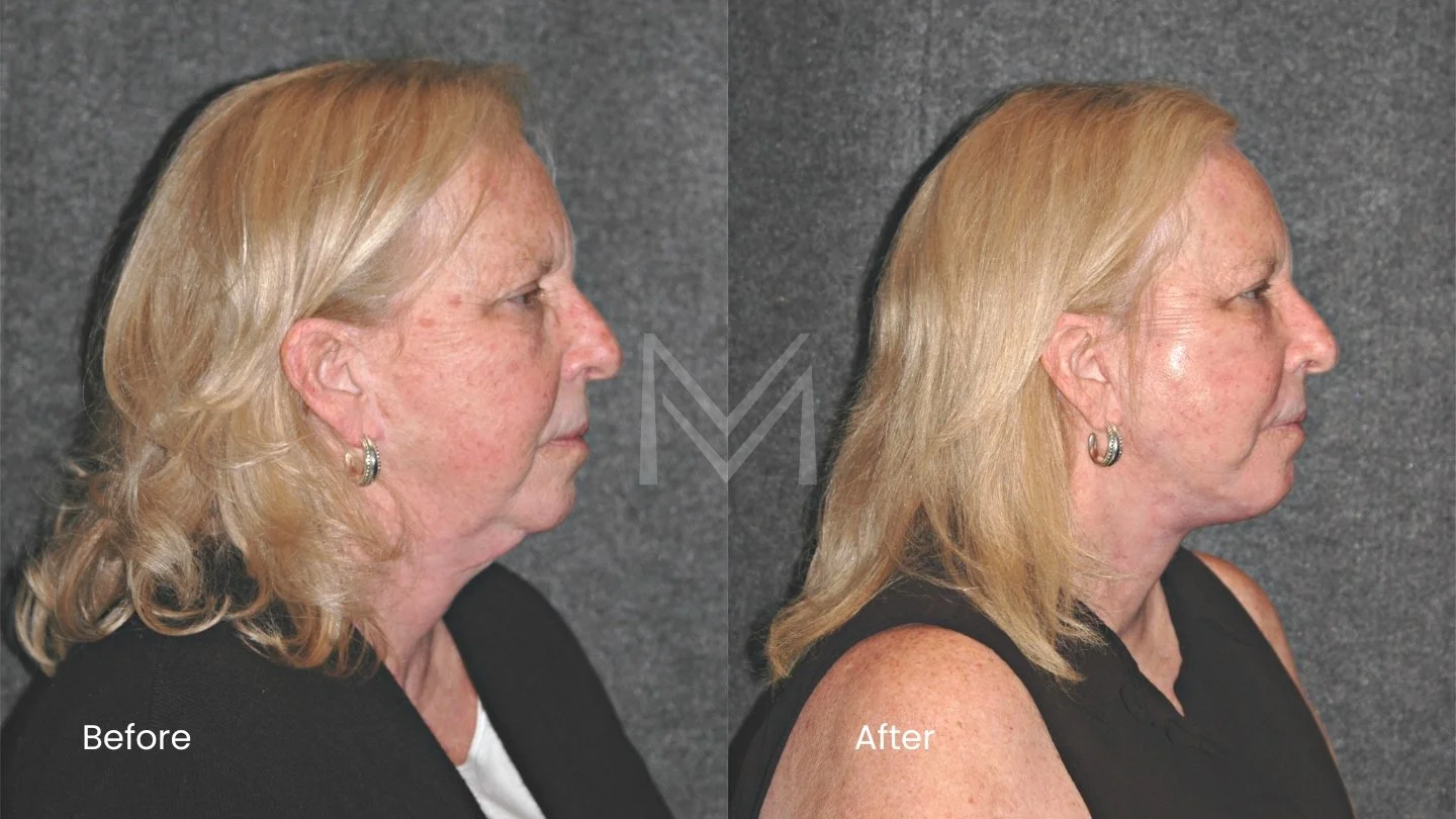 Revision extended deep plane facelift, revision neck lift, and CO2 laser resurfacing patient — side view