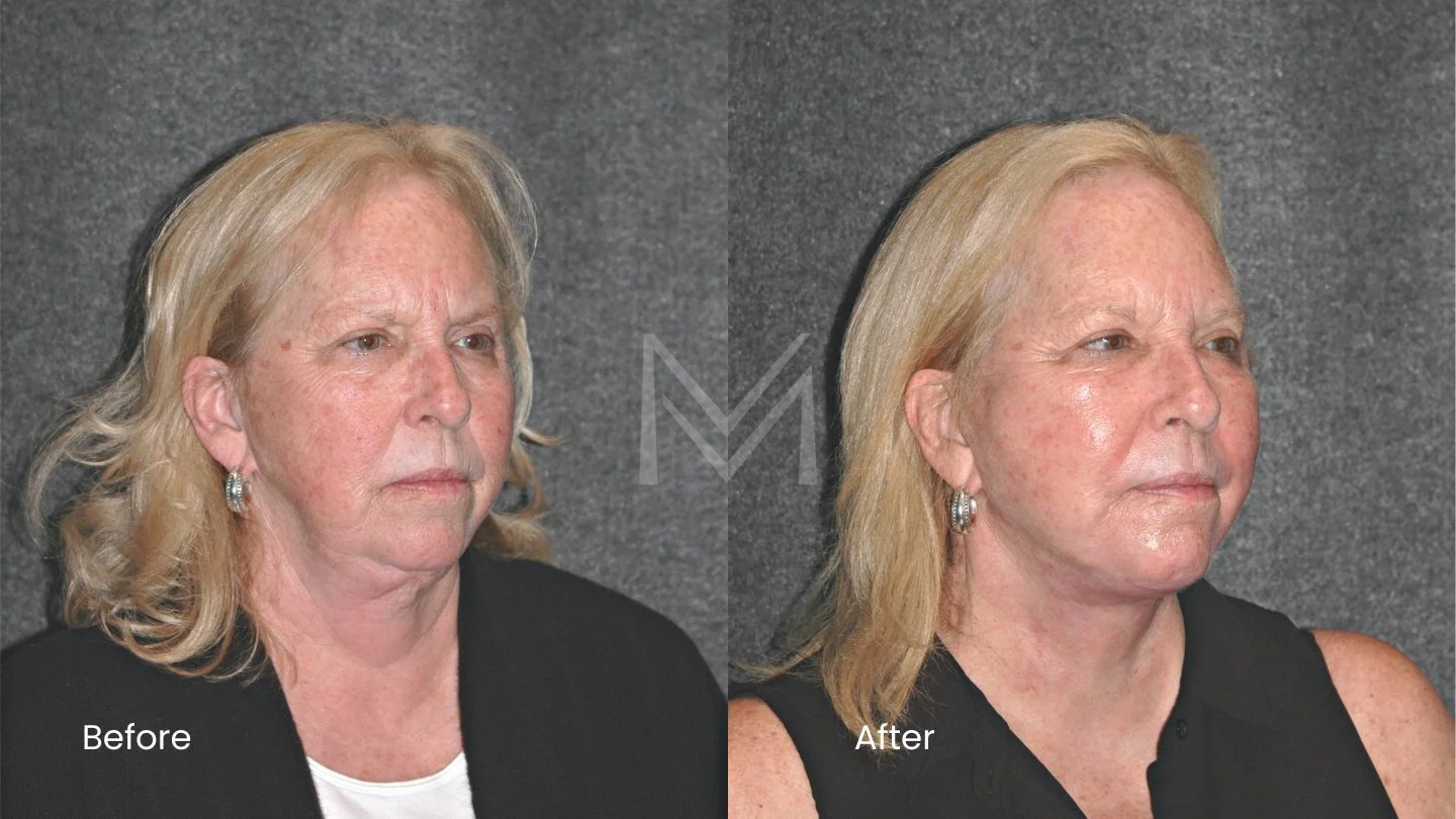 Revision extended deep plane facelift, revision neck lift, and CO2 laser resurfacing patient — angled view